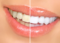 Before/After Teeth Whitening McCandless PA