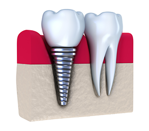 Dental Implants | Dentist in Pittsburgh, PA |  Gary M Carmassi, DMD
